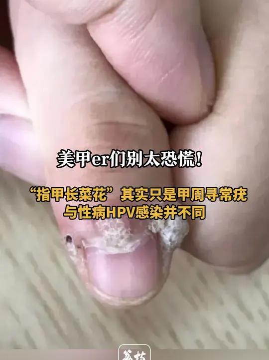 指甲长菜花不是性病HPV感染 医生:不必过度恐慌 美甲后为什么会感染HPV 22岁吴女士是