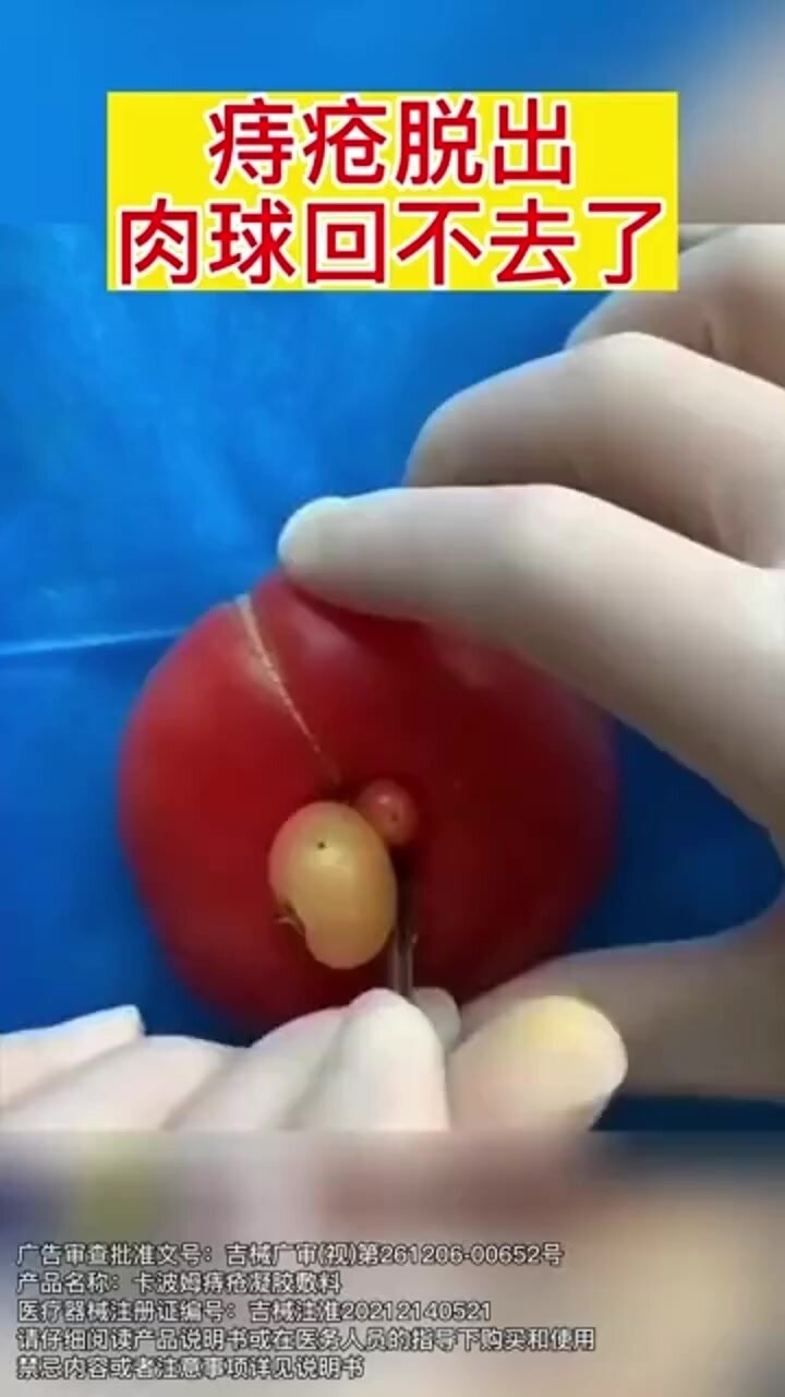 肛门有个肉疙瘩,是痔疮吗?教你一招
