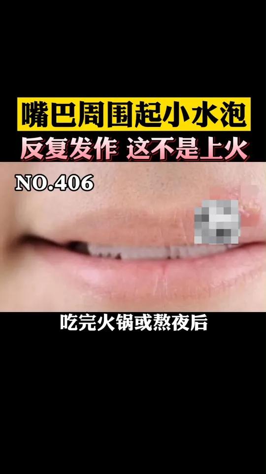 嘴巴周围长小水泡,不是上火,是会传染的单纯疱疹,这样处理好得快