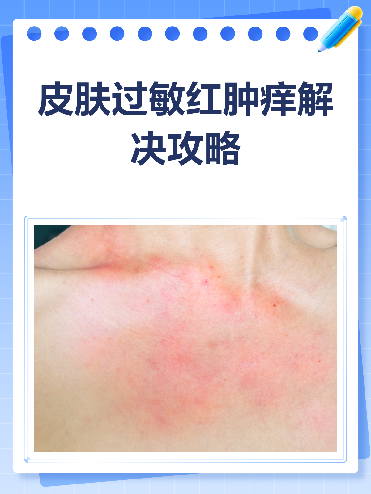 皮肤过敏大面积红肿痒?别急,这样做!