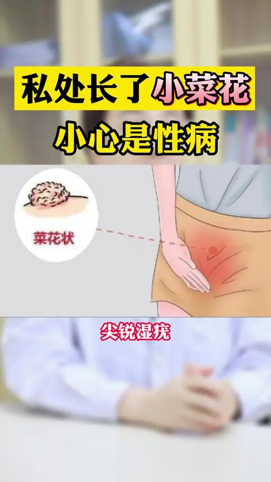 私处长了小菜花,可能是性病!要及时到医院检查,不要耽误治疗时机!HPV 尖锐湿疣