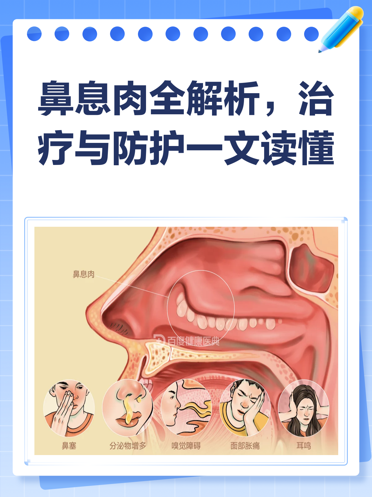 鼻息肉知多少?揭秘鼻腔里的“不速之客”!