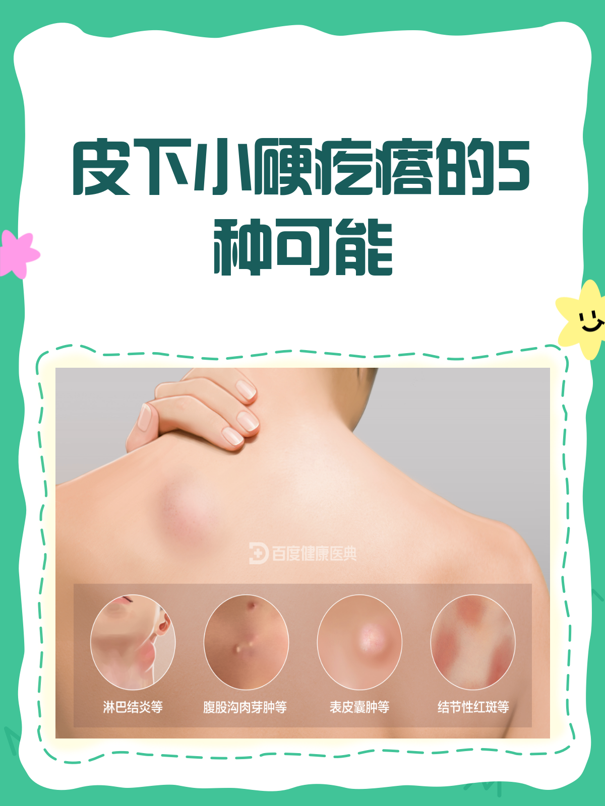 皮下小硬疙瘩?揭秘背后的“真凶”!