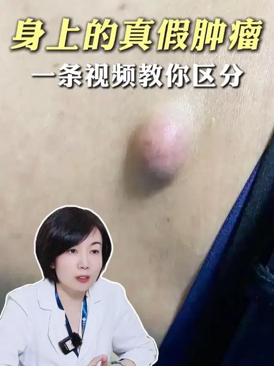 身上突然冒出来的肉球都是啥啊？三甲皮肤科主任一条视频教你区分清楚！