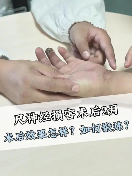 尺神经损害术后2月术后效果怎样?如何锻炼
