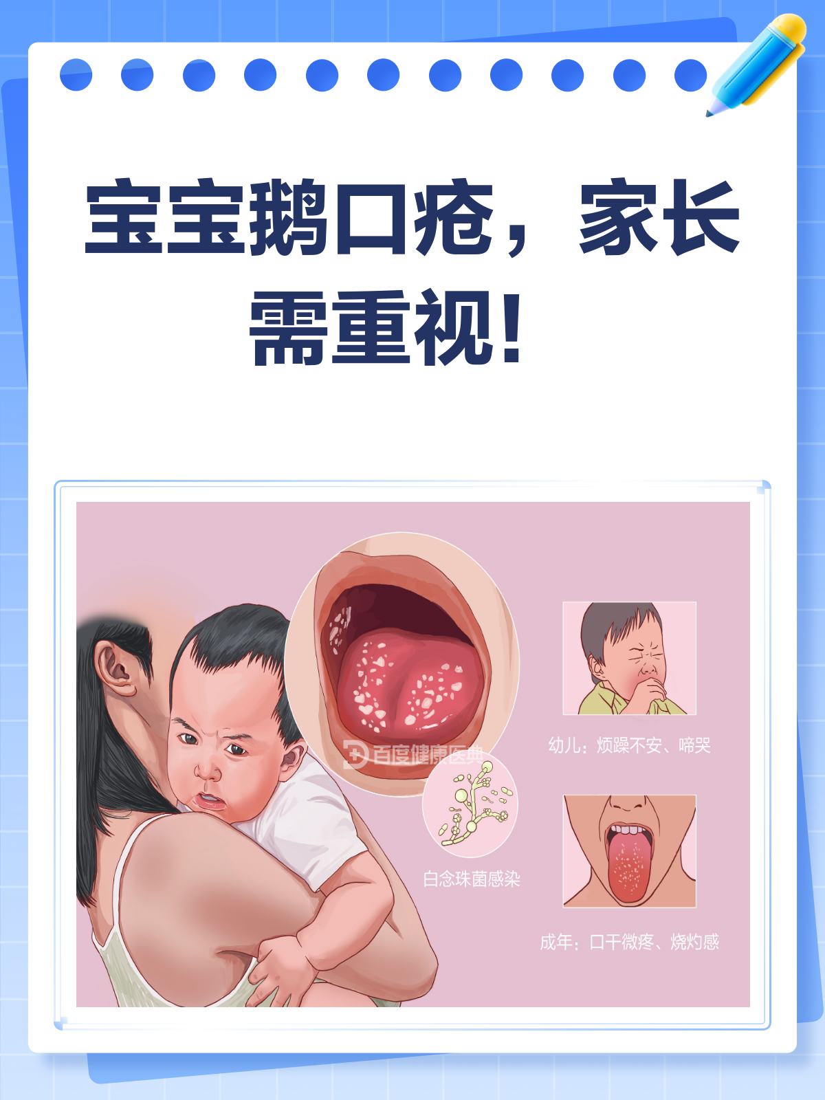 宝宝得了鹅口疮?别急,看完这篇就懂了