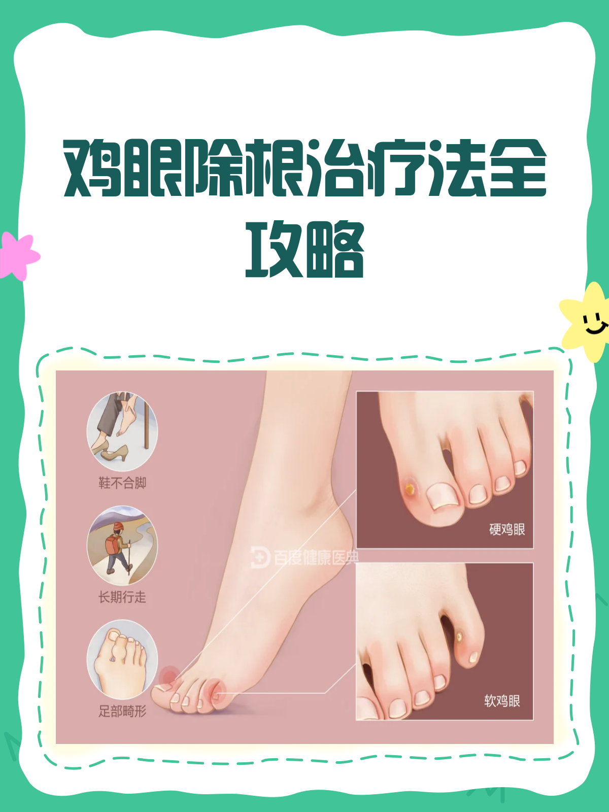 鸡眼除根全攻略告别疼痛烦恼！