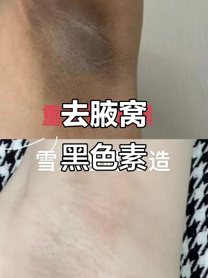 腋下黑色素沉淀怎么办?教你轻松去除