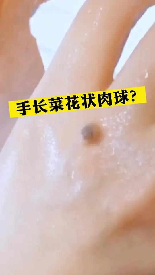 小看!手上这种菜花状小疙瘩,小心会传染!寻常疣 健康 科普