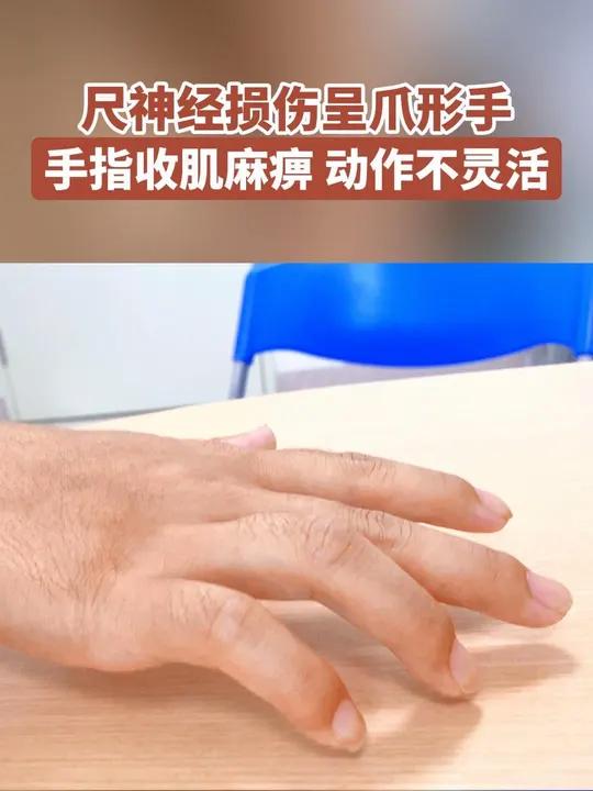 爪形手是尺神经损伤时,大部分手内收肌麻痹,造成握力减弱,持物不稳,动作不灵活等