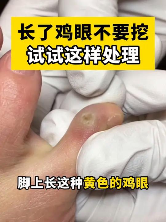 长了鸡眼,走路特别疼!跟着医生这样处理