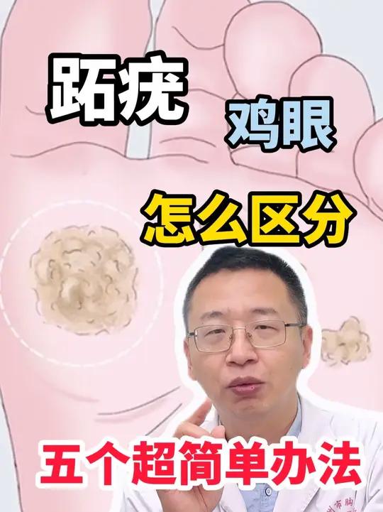 鸡眼跖疣怎么区分 五个超简单办法
