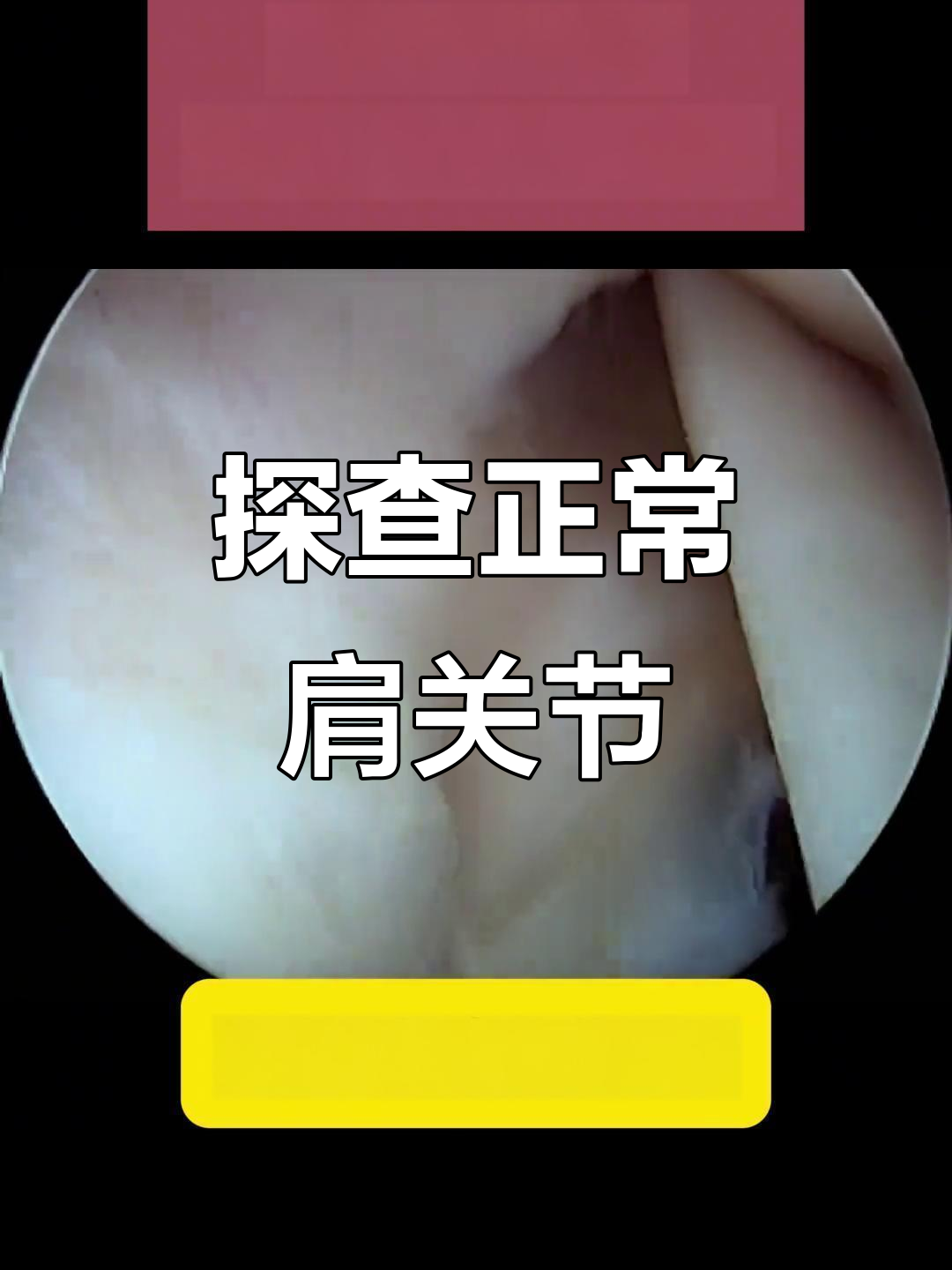 肩关节内部结构揭秘：肱二头肌与鱼唇损伤解析