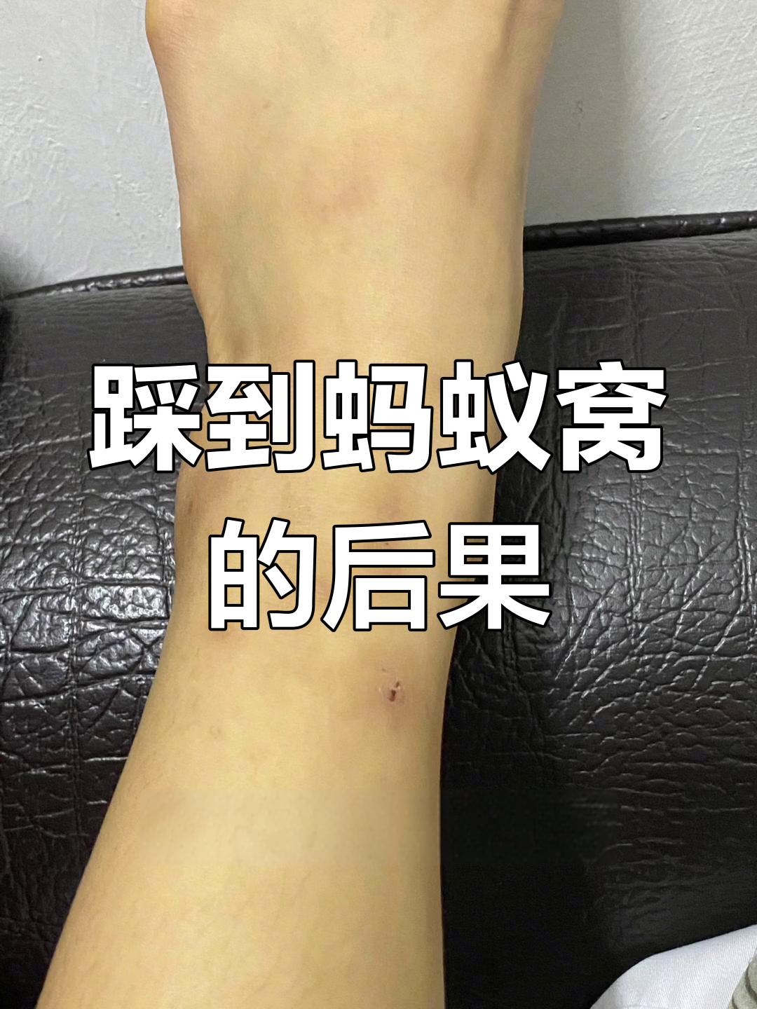 被蚂蚁咬后的真实反应,从红肿到恢复全过程