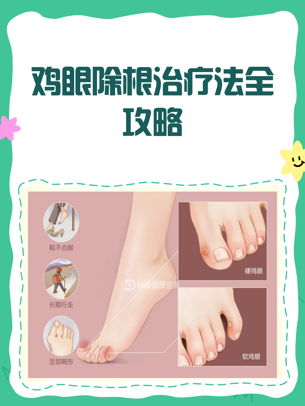 鸡眼烦恼别再有!这样治疗能除根