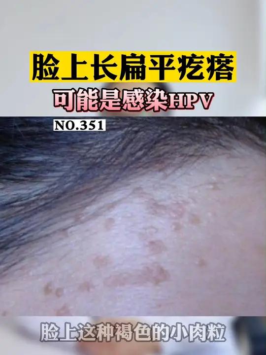 脸上长褐色小肉粒,要及时处理!