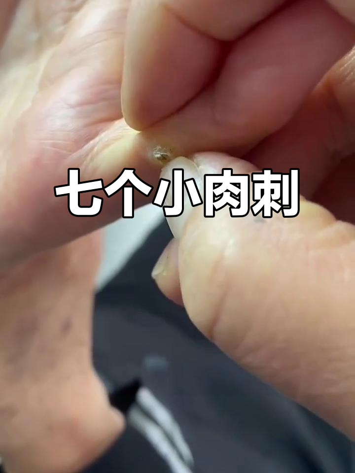 手指上的肉刺包,竟然有七个!