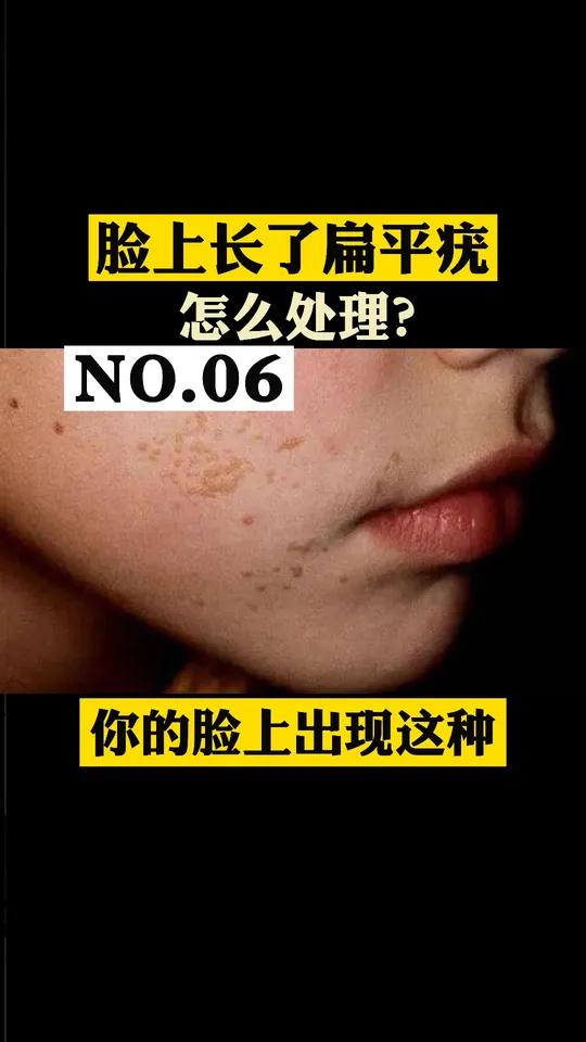 你的脸上出现这种扁平丘疹可能就是扁平疣医学科普应该怎么解决呢