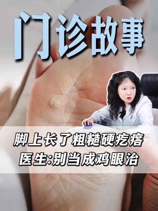 脚上长粗糙硬疙瘩，上面还有小黑点，千万别把它当#鸡眼 治了！#跖疣 #HPV感染 #疣 #