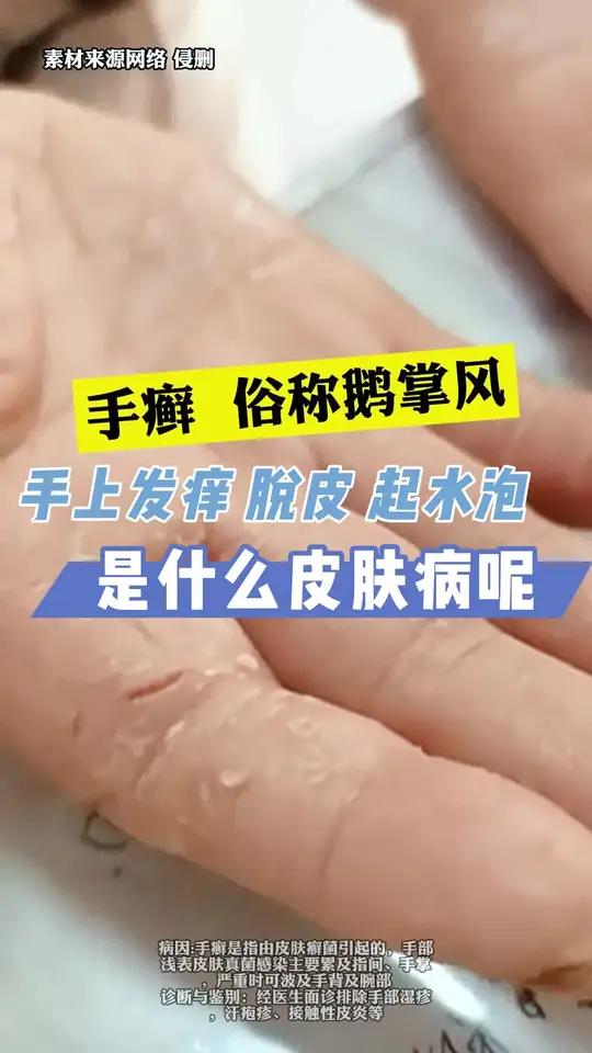 手部起水泡,痒还脱皮,这可能考虑