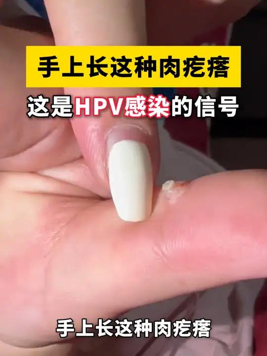 手上长硬硬的肉疙瘩,当心是 hpv感染的信号!