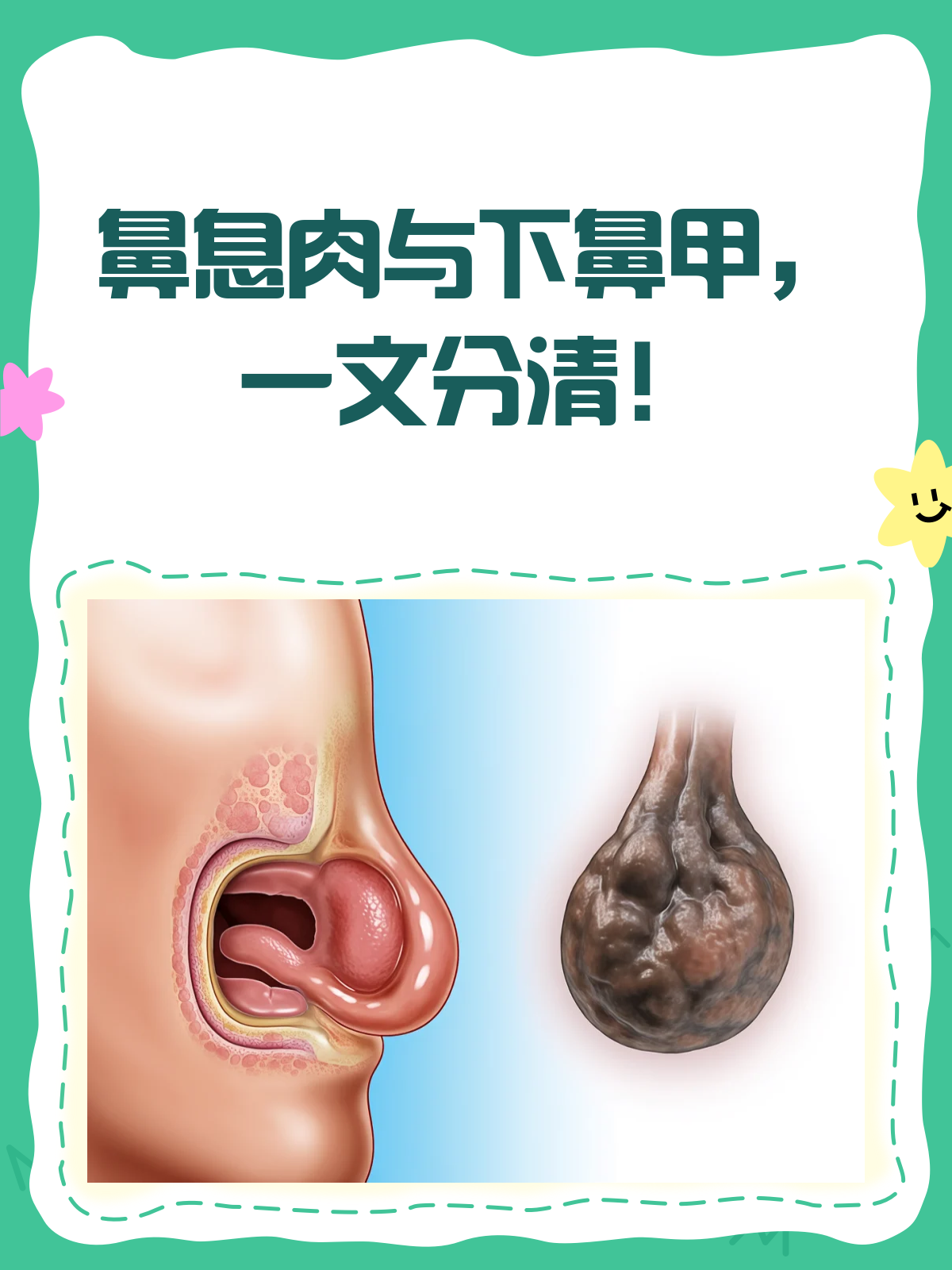 鼻子里红肉球≠鼻息肉!一文带你认清真相