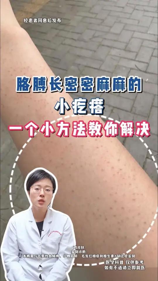 胳膊长密密麻麻的小疙瘩，一个小方法教你解决鸡皮肤毛周角化