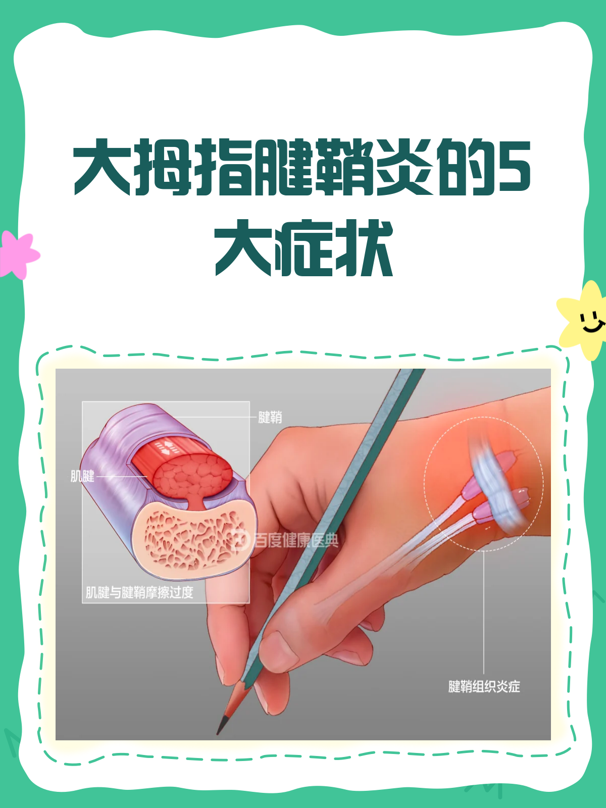 大拇指腱鞘炎来袭?疼痛弹响需警惕!