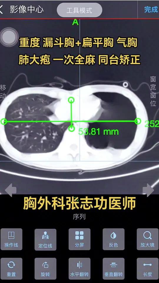 19岁 成年人重度 漏斗胸+ 扁平胸 气胸肺大疱一次全麻 同台矫正