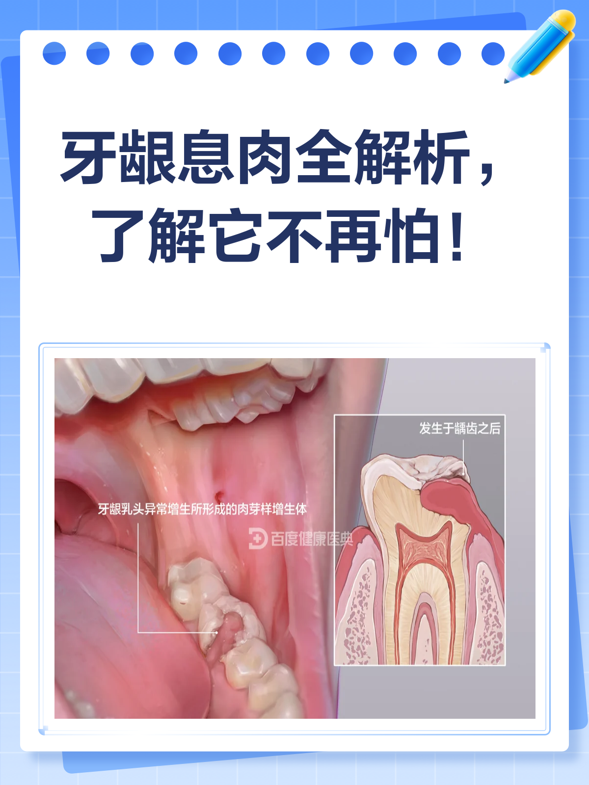 牙龈上的“不速之客”牙龈息肉知多少?