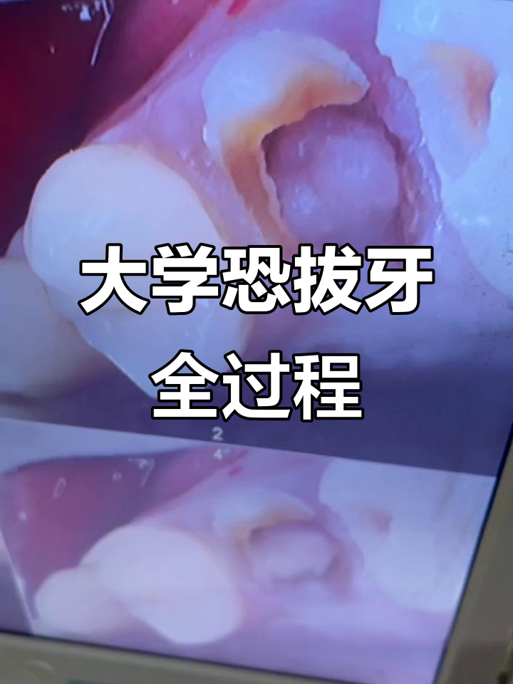 22岁大学生因牙根腐烂恐惧拔牙,过程血腥真实记录
