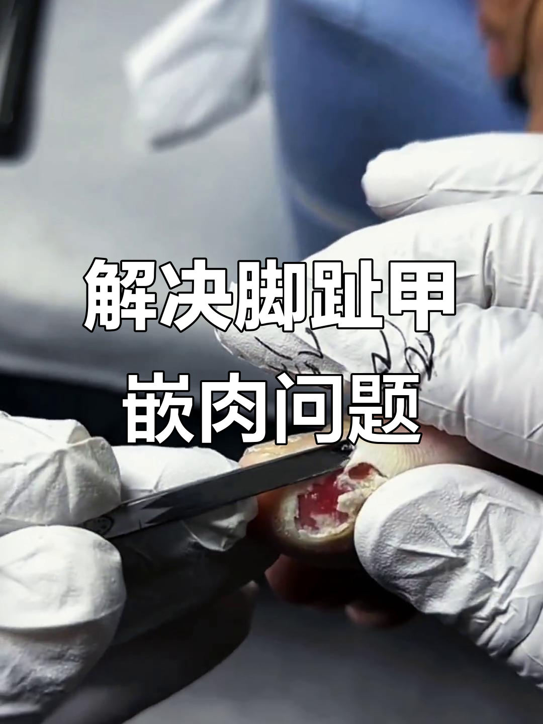 脚指甲长肉里怎么办?修脚大师轻松解决!