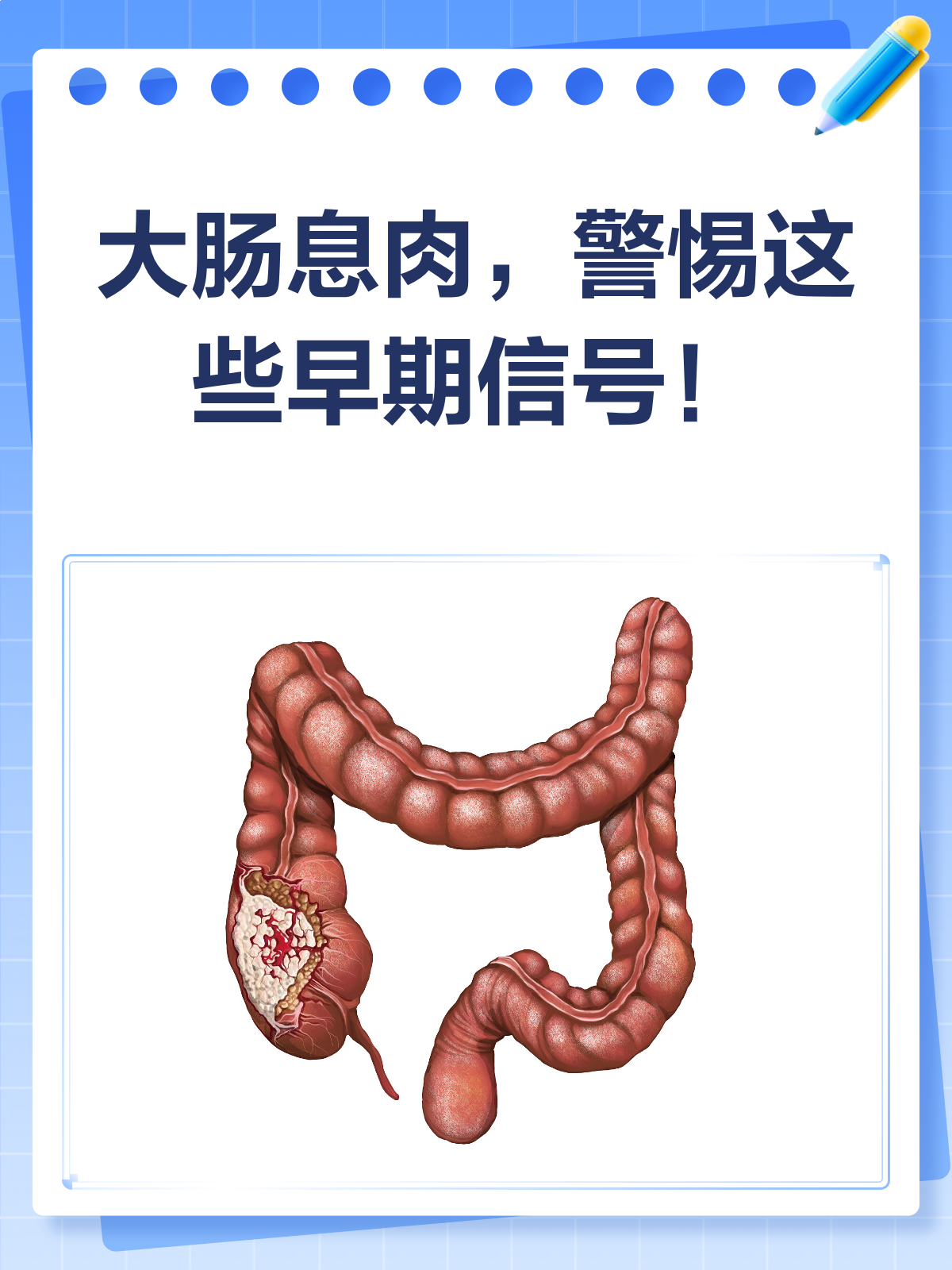 大肠息肉悄然而至?早期信号别忽略!