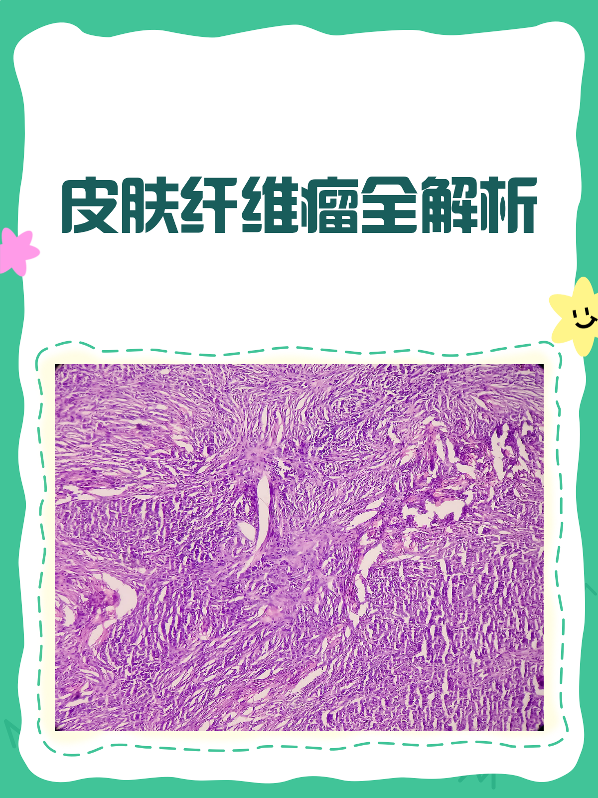 皮肤纤维瘤全解析，良性小瘤别慌张！