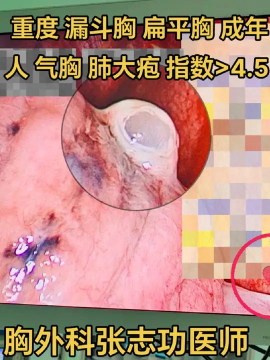 重度 漏斗胸+ 扁平胸 成年人合并气胸肺大疱Haller指数>4.5
