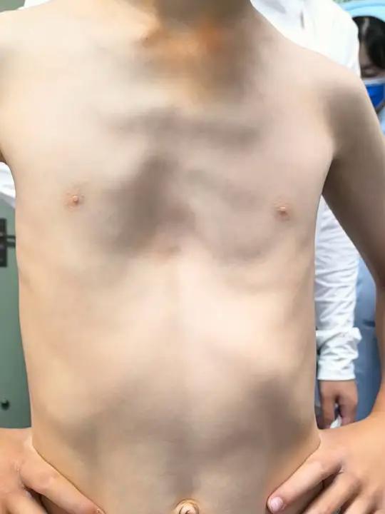 7周半宝宝来门诊,漏斗胸很严重。其实在一周岁的时候就发现了。鸡胸 健康科普 门诊日常