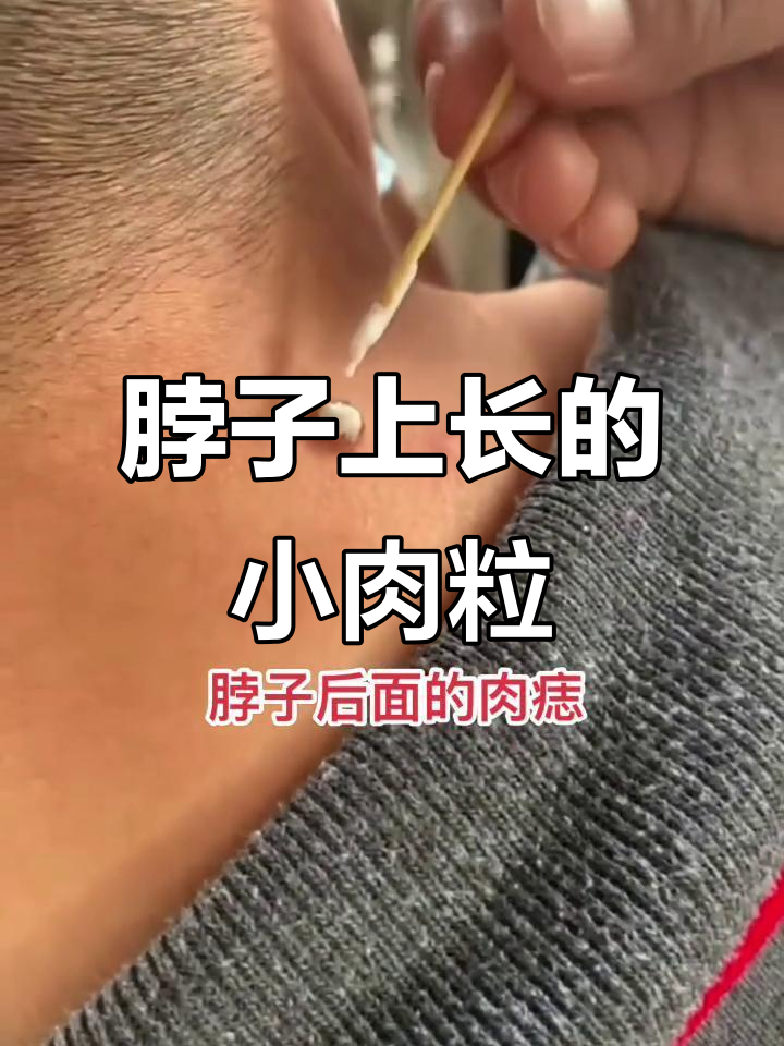脖子上的古琴痣，凸起小肉粒如何处理？