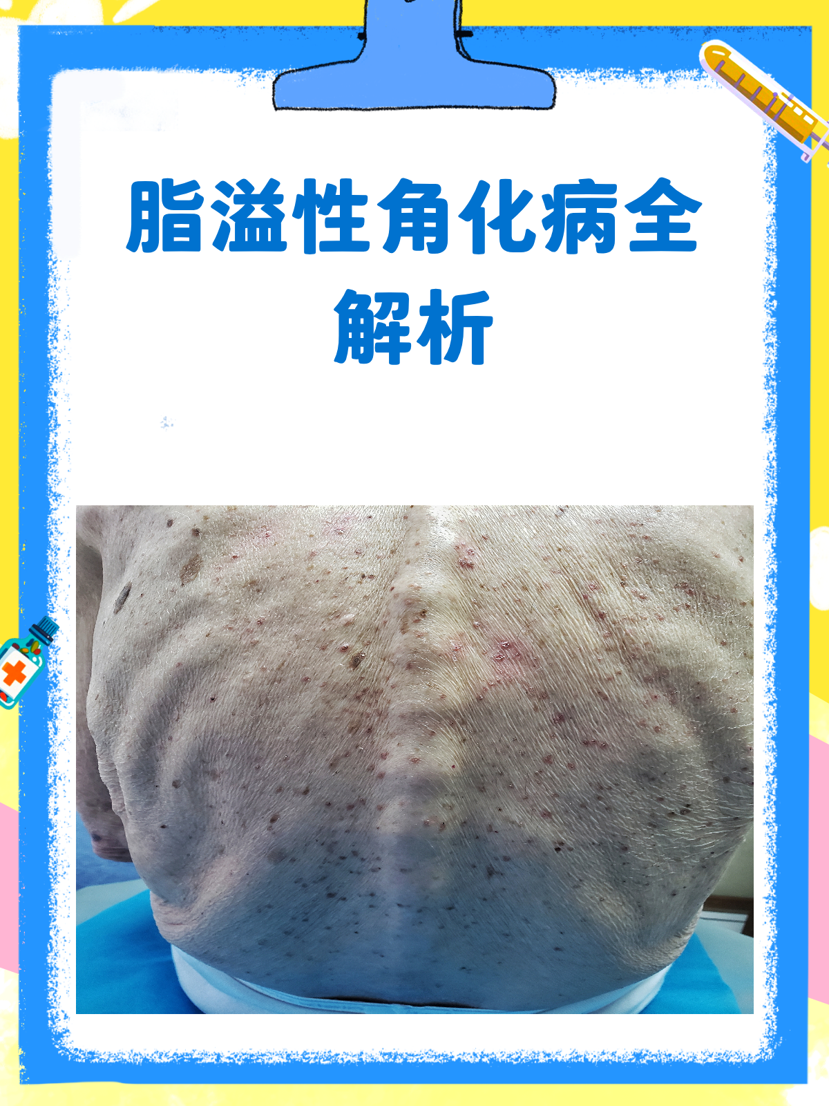 脂溢性角化病大揭秘！皮肤上的小肉瘤是啥？