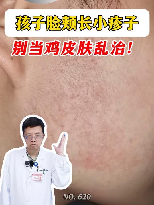 孩子脸颊长小疹子,别当鸡皮肤乱治!