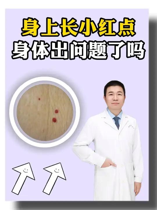 身上长了一些小红点,是身体出现问题了吗?樱桃状血管瘤 健康科普 硬核健康科普行动