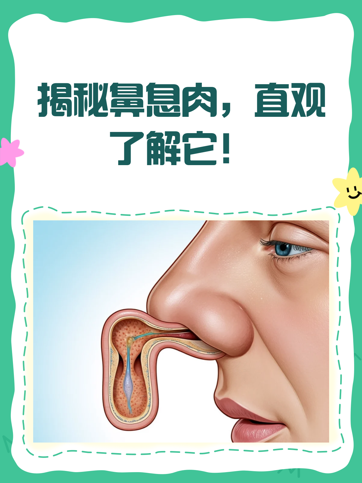 鼻息肉真面目揭秘!看图识病不再难!