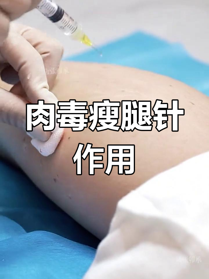 肉毒素瘦腿原理揭秘:让小腿肌肉萎缩,效果立竿见影