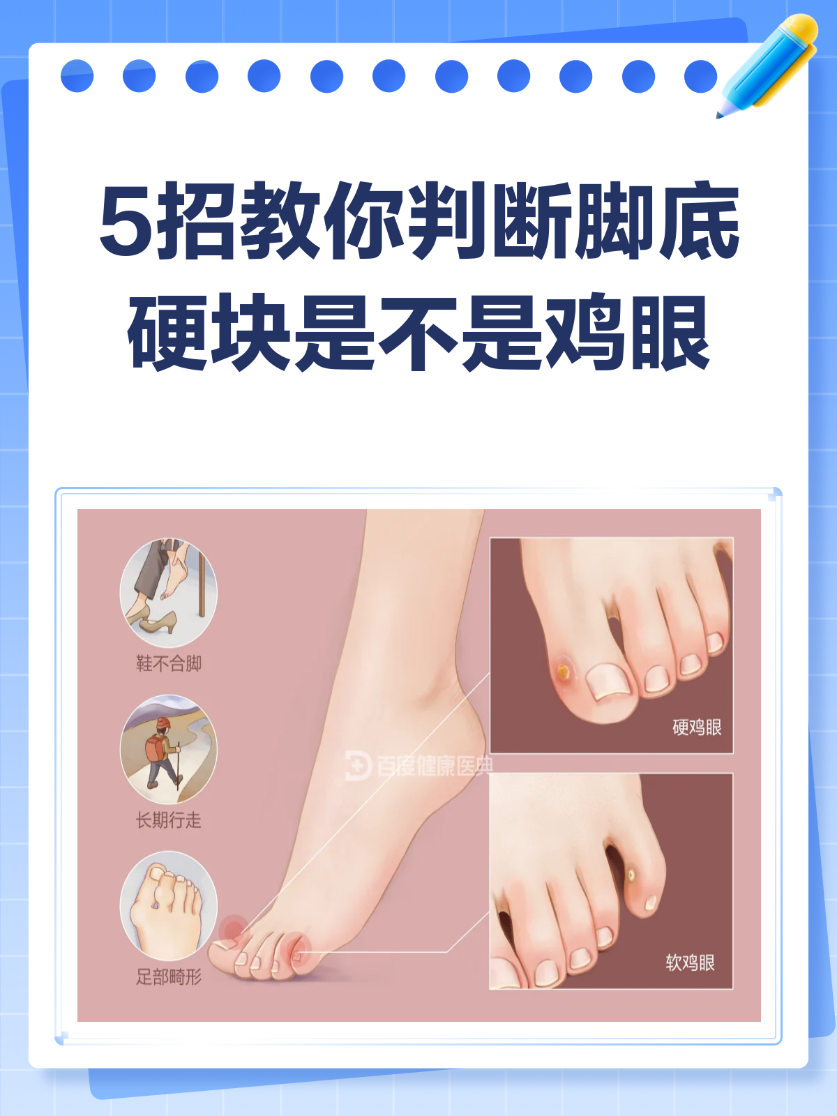 脚底长硬块?教你5招判断是不是鸡眼!