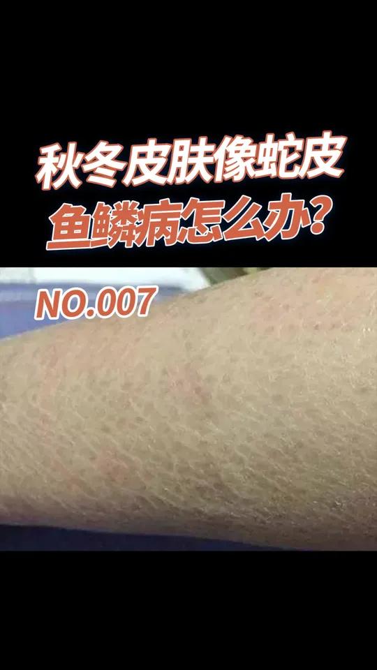 秋冬季节皮肤干燥像蛇皮,得了鱼鳞病,记得这样做!
