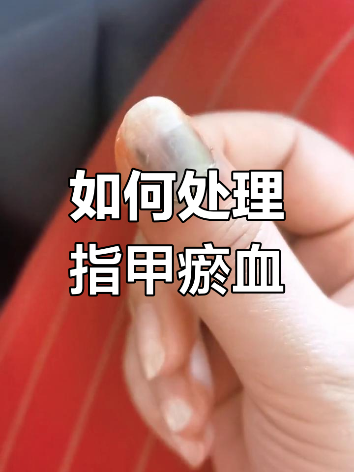 指甲被门夹后瘀血怎么处理?放血的正确方法分享