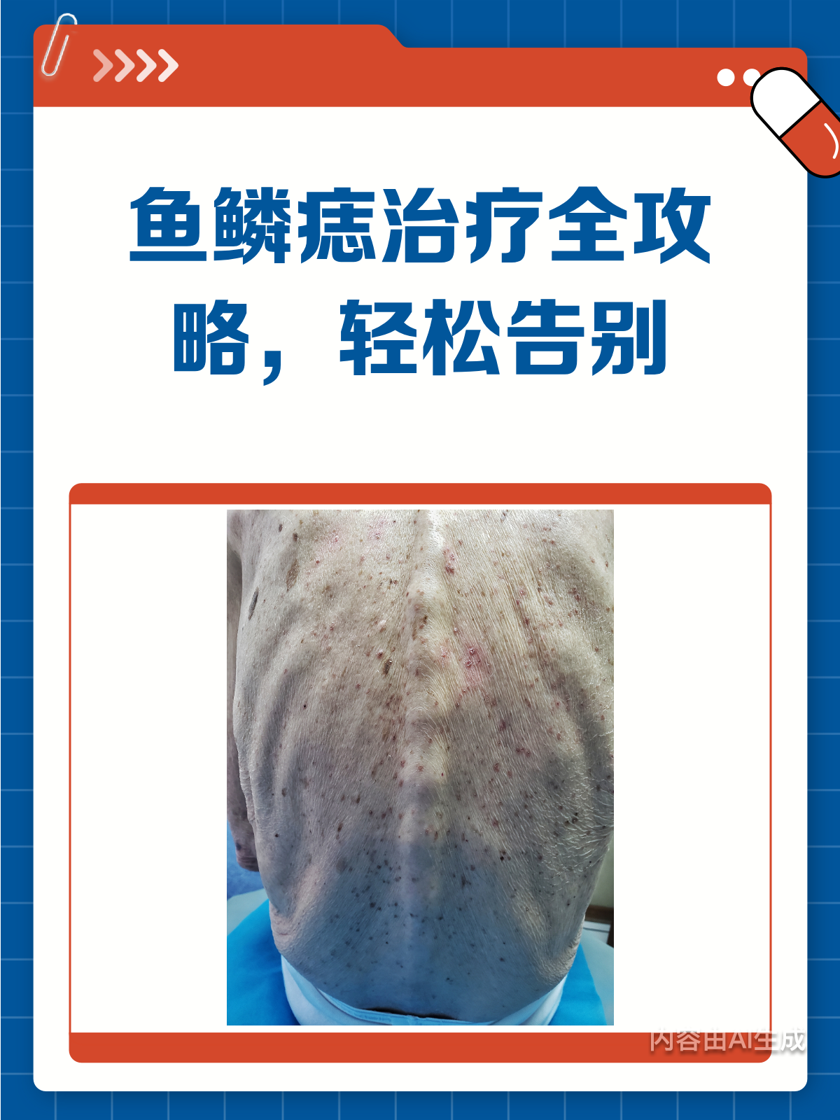 鱼鳞痣治疗全攻略,轻松告别小烦恼!