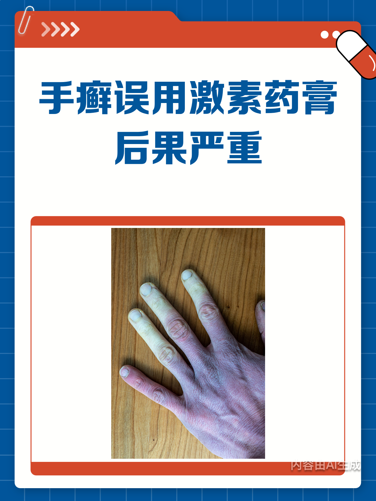 手癣别乱用激素药膏!小心越治越糟