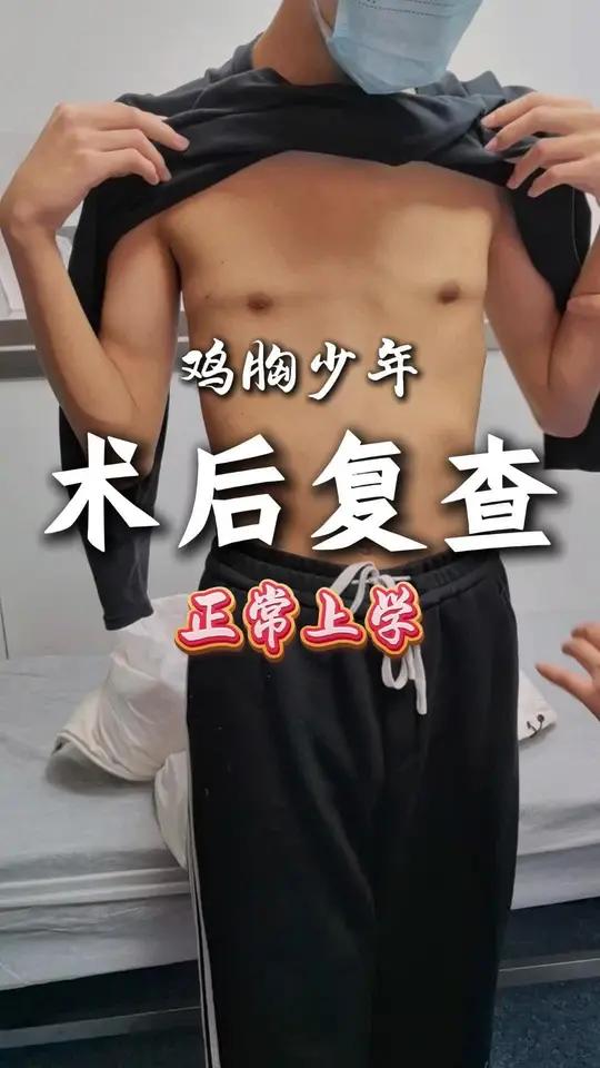 鸡胸手术后影响上学吗?来自山西的17岁少年复查,恢复的不错!家长和孩子比较满意。鸡胸 健康