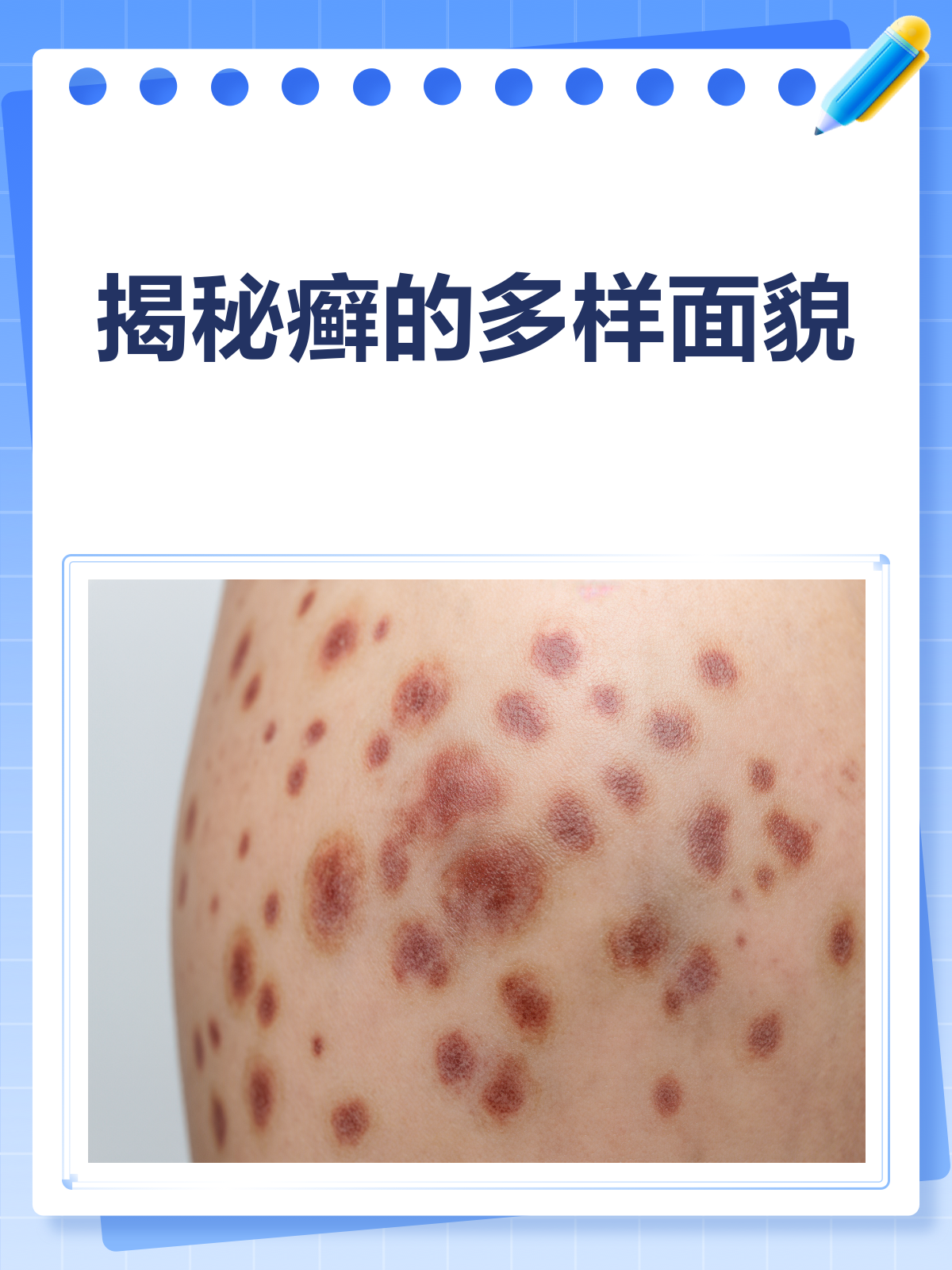 揭秘癣的真面目!不同部位,样子大不同