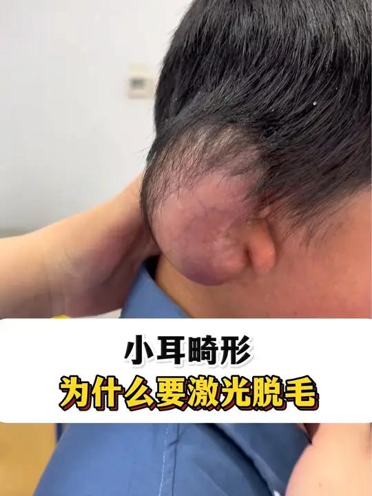 小耳畸形
